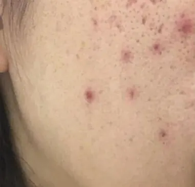 Sebelum (Day 1): pipi dengan jerawat aktif kemerahan