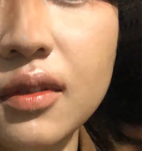 Sesudah (Day 14): kulit wajah tampak lebih tenang dan rata