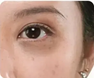 Area bawah mata dengan lingkaran gelap sebelum memakai cushion
