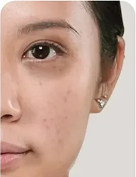 Shade Light: wajah dengan noda jerawat sebelum memakai cushion