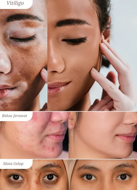 Sebelum dan sesudah HD Foundation pada vitiligo, bekas jerawat, dan mata gelap